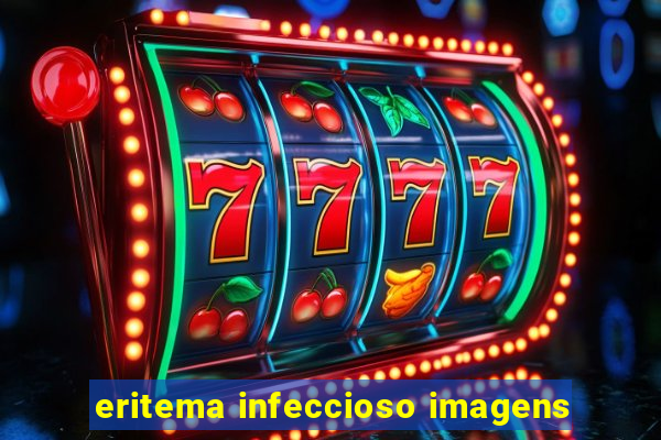 eritema infeccioso imagens